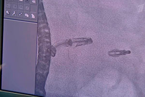 Сюжет программы «Доброе утро» Первого канала Сердце, не болей!