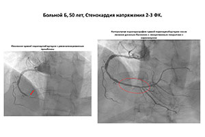 Курс по лечению стенозирующего поражения коронарных артерий