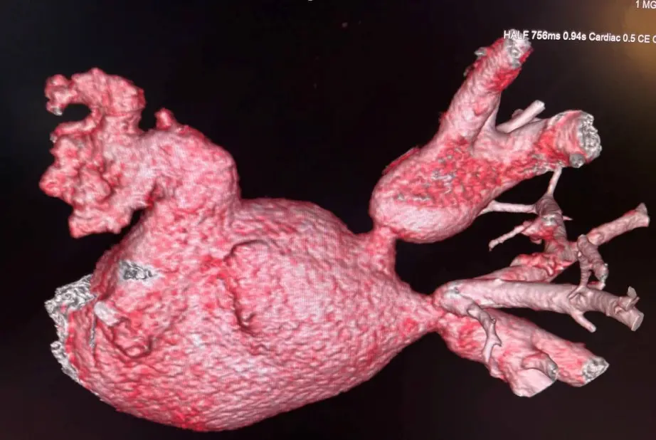 МСКТ 3d реконструкция левого предсердия