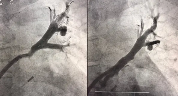 Левая верхняя легочная вена