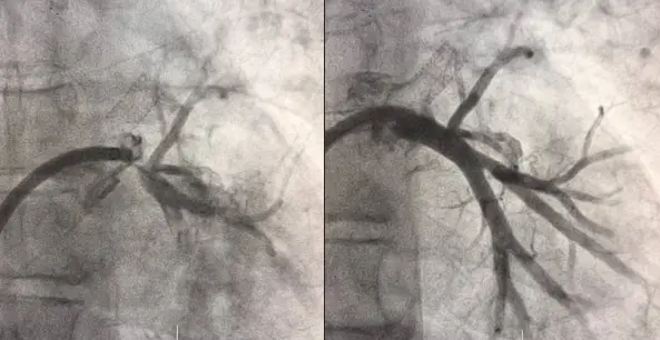 Левая нижняя легочная вена до и после стентирования