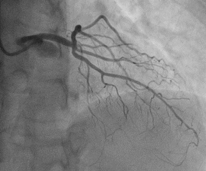 pulmonary hypertension