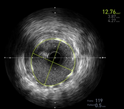 pulmonary hypertension