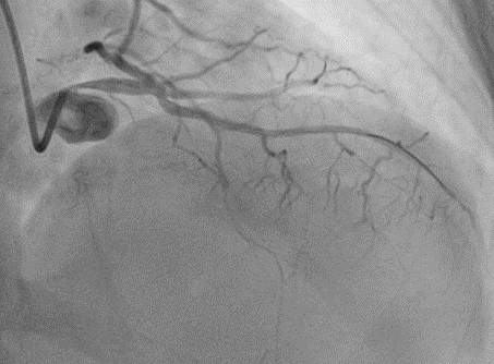 pulmonary hypertension