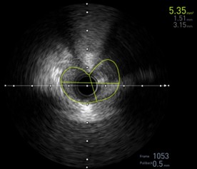 pulmonary hypertension