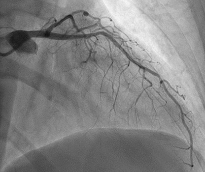 pulmonary hypertension