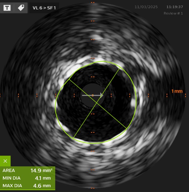 pulmonary hypertension
