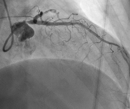 pulmonary hypertension