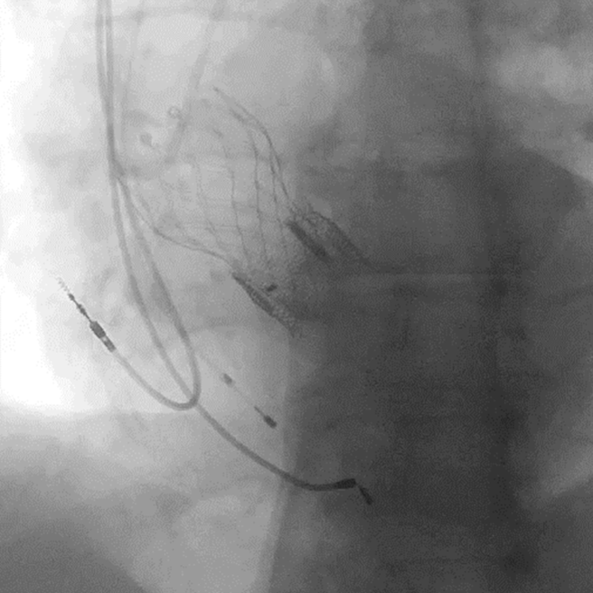 аортальный клапан