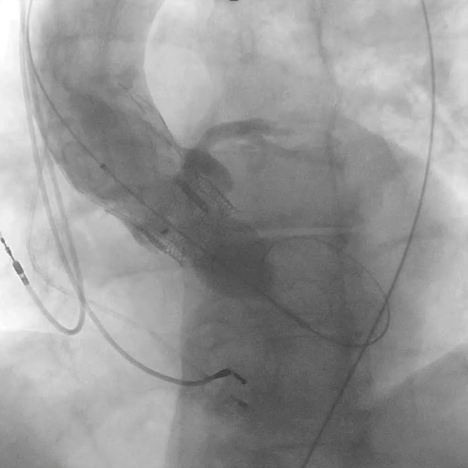 аортальный клапан