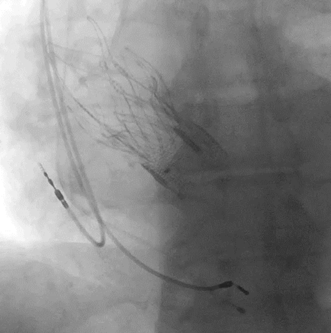 аортальный клапан