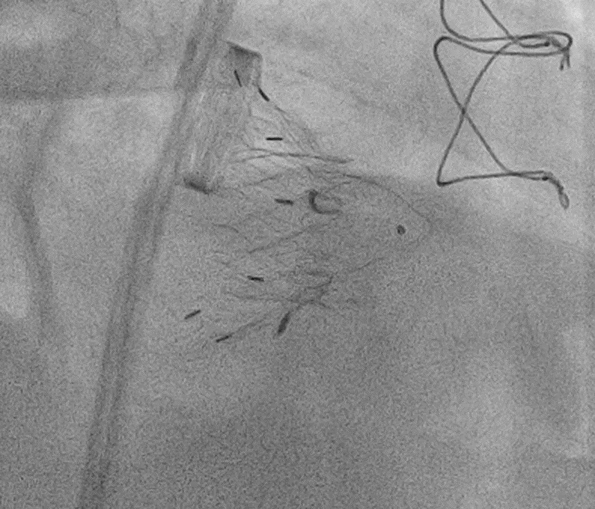 транскатетерная имплантация трикуспидального клапана